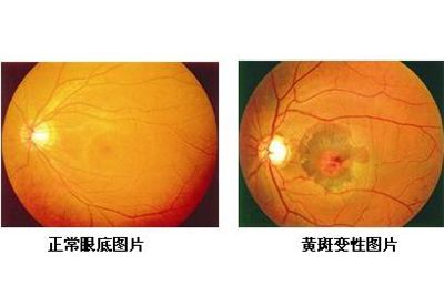 眼底黄斑出血最新治疗方法的研究与探讨